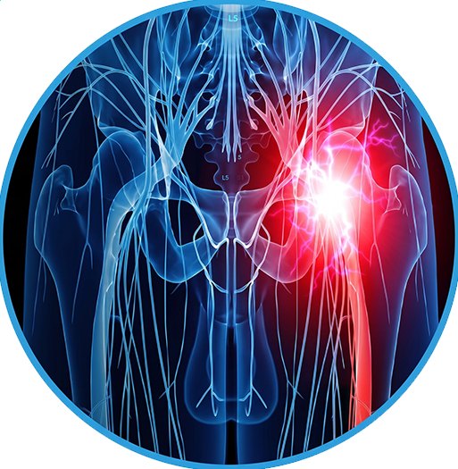 Sciatica